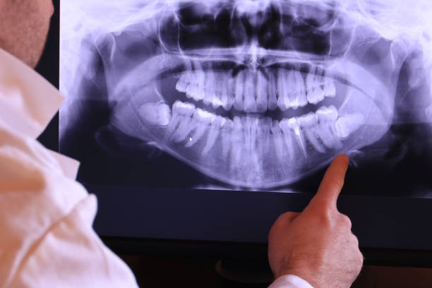 Best Emergency Wisdom Teeth Removal in Laguna Hills, CA